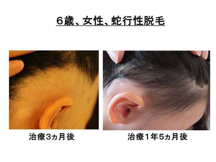 円形脱毛症　病院